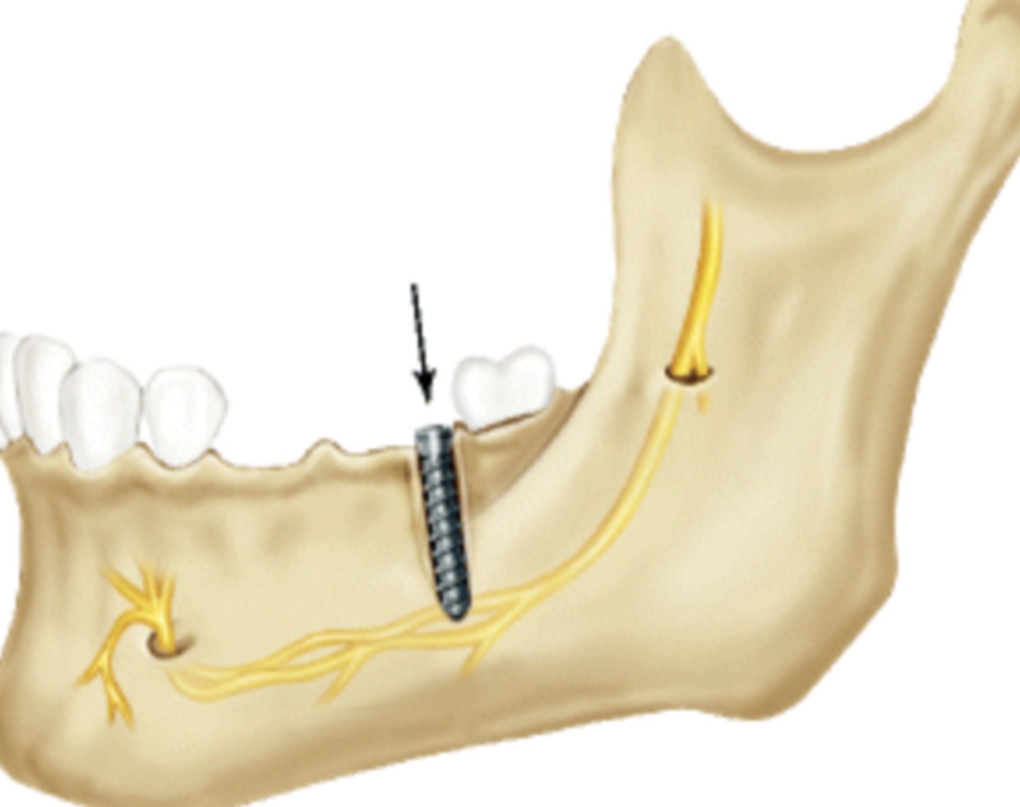<p>Reposition or remove the implant immediately before osseointegration to create at least a 2 mm separation from the canal.</p>