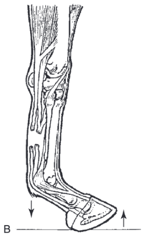 <ul><li><p><span>MCP/MTP joint is hyperextended (dropped) when limb is loaded</span></p></li><li><p><span>Toe is raised from the ground</span></p></li></ul>