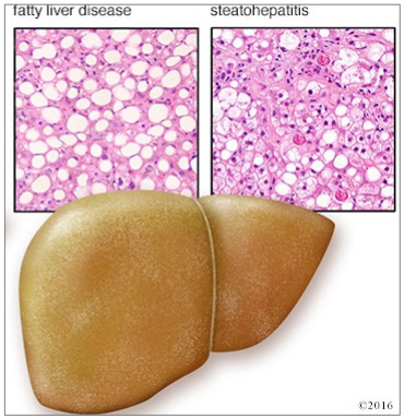 <p><mark data-color="red" style="background-color: red; color: inherit">- Accumulation of fat </mark><strong><mark data-color="red" style="background-color: red; color: inherit">AND hepatocyte injury with fibrosis</mark></strong></p><p>- Caused by many things e.g.: <mark data-color="blue" style="background-color: blue; color: inherit">Oxidative stress, acetaldehyde accumulation and altered protein function</mark></p><p>-<strong><mark data-color="blue" style="background-color: blue; color: inherit">Usually improves with abstinence although proportion patients will develop cirrhosis despite abstinence</mark></strong></p>