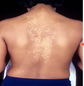 <p><strong>Discolored patches</strong> on the skin caused by Malassezia furfur</p>