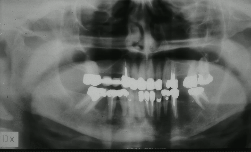 <p>no history antiresorptative medication, no history of cancer, no pain most likely diagnosis?</p>