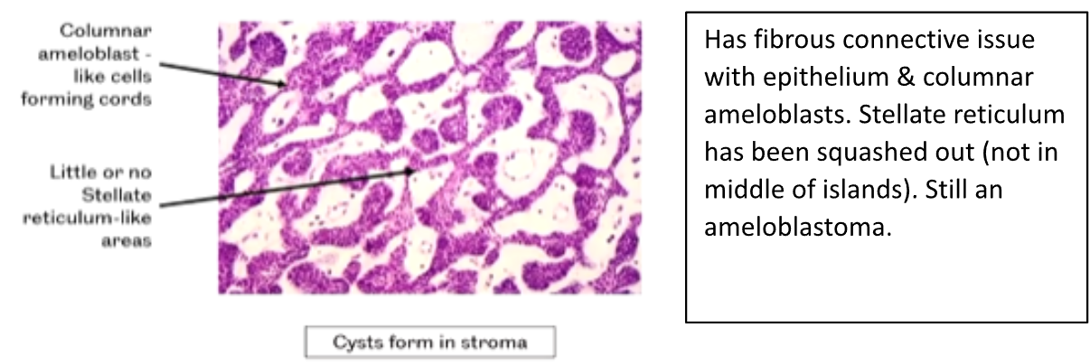 <p>1) Columnar Ameloblasts - like cells forming Cords</p><p>2) Little or No Stellate Reticulum like areas</p><p>3) Cysts form in the Stroma</p>