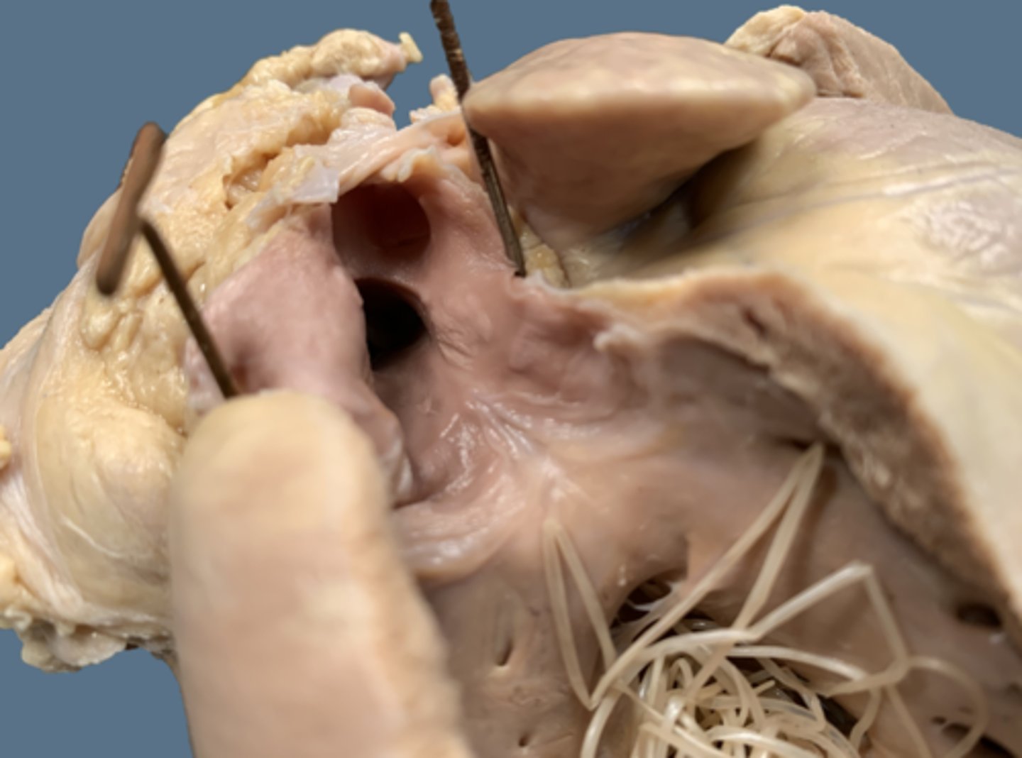 <p>What happens to the left side of a heart with heartworms?</p>
