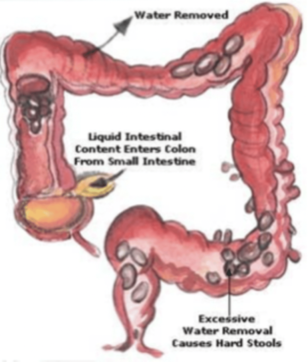 <p>difficulty in passing stools</p><p>- hard, dry stool</p><p>- in children, often presents w/ urinary issues</p>