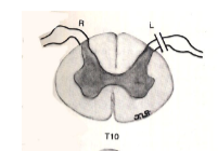 <p>a lesion here would result in what clinical presentation?</p>