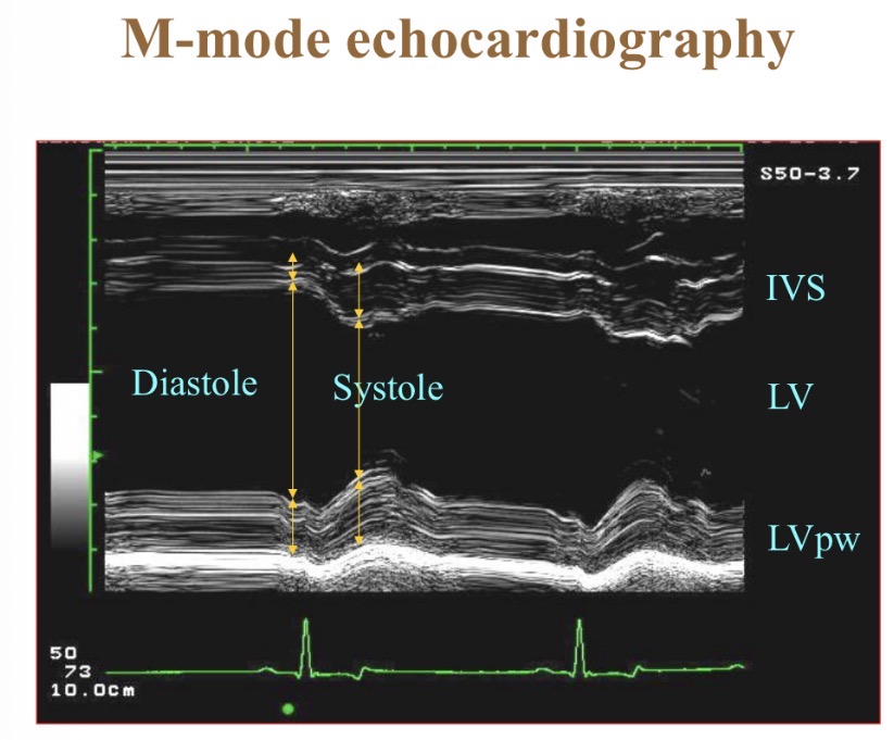 <p>What does M-mode echocardiography show </p>