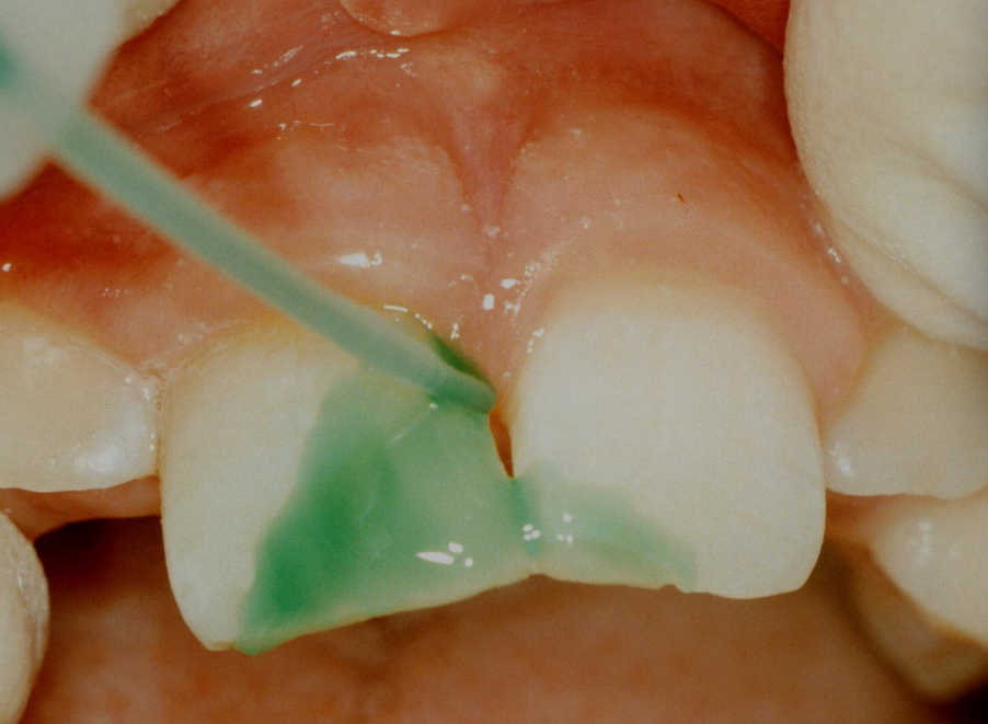 <p>etchant is briefly applied then washed away&nbsp;</p>