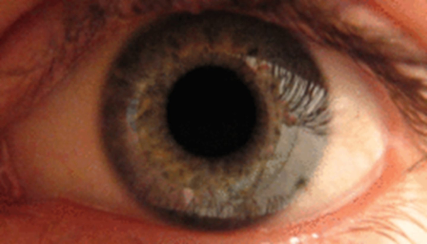 <p>What 2/3 etiology with the nerve causing a large pupil is shown here?</p>