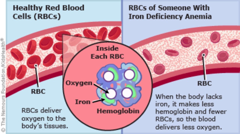 <ol><li><p>Hemoglobin cannot form correctly in the RBC, if there is no Iron present.</p></li><li><p>Heme contains one Iron ion which is critical for binding O2, therefore the RBC won’t be able to transport O2, creating an Anemia specifically Iron deficiency Anemia.</p></li></ol>