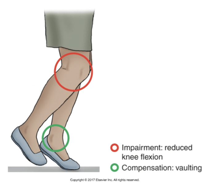 <p>Vaulting through excessive plantarflexion of the unaffected stance limb is used to compensate for limited functional shortening of affective swing limb like when having a knee braced in full extension</p>