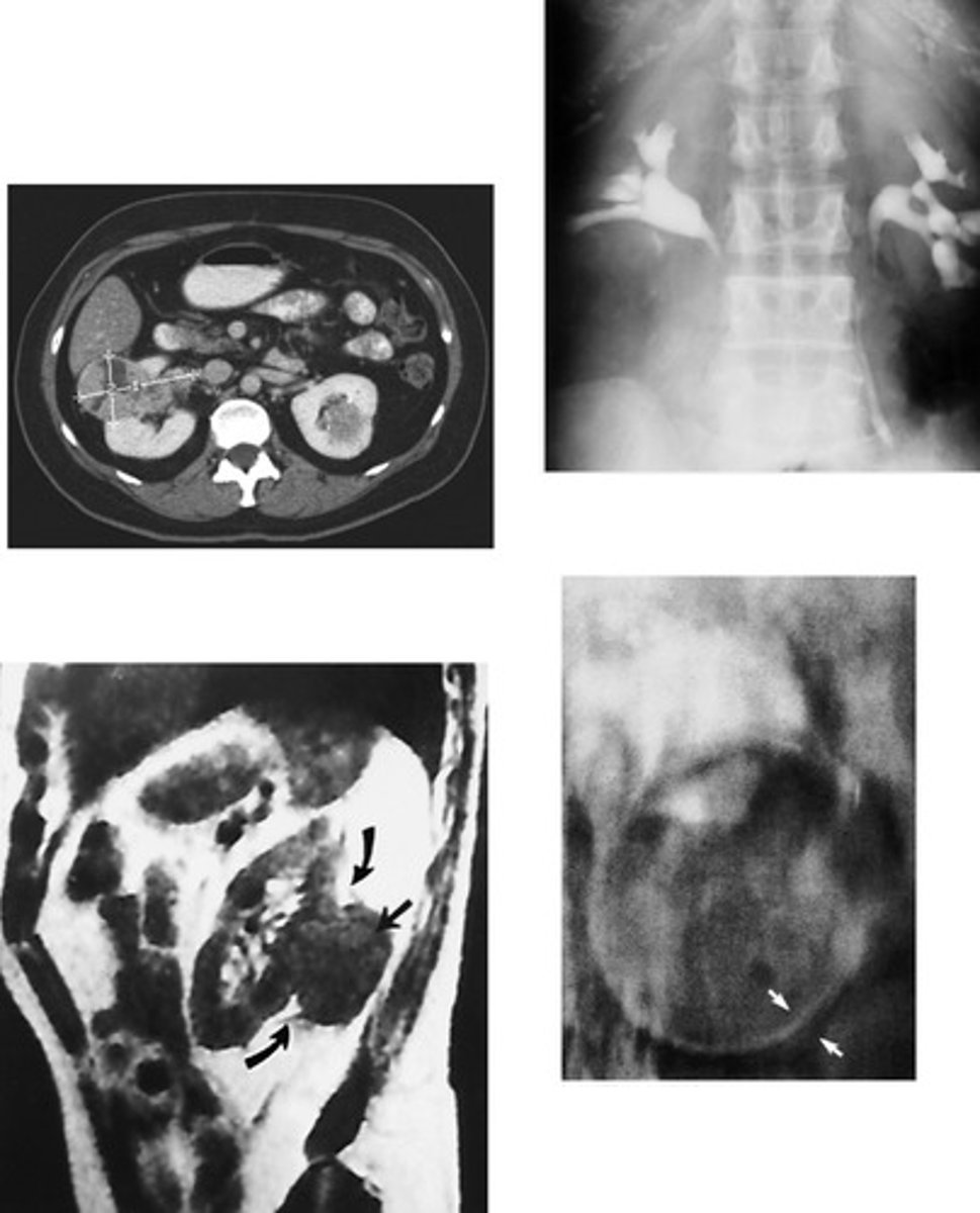 <p>- What is the most common type of renal neoplasm in adults?</p><p>- What age range does this affect?</p><p>- What is the most common symptom associated with this pathology?</p><p>- If there is calcification within the mass, what does this indicate?</p><p>- What part of the kidney becomes distorted and irregular?</p><p>- What imaging modalities demonstrate metastasis?</p><p>- What is the most common treatment of this pathology and what is the survival rate after this treatment?</p>