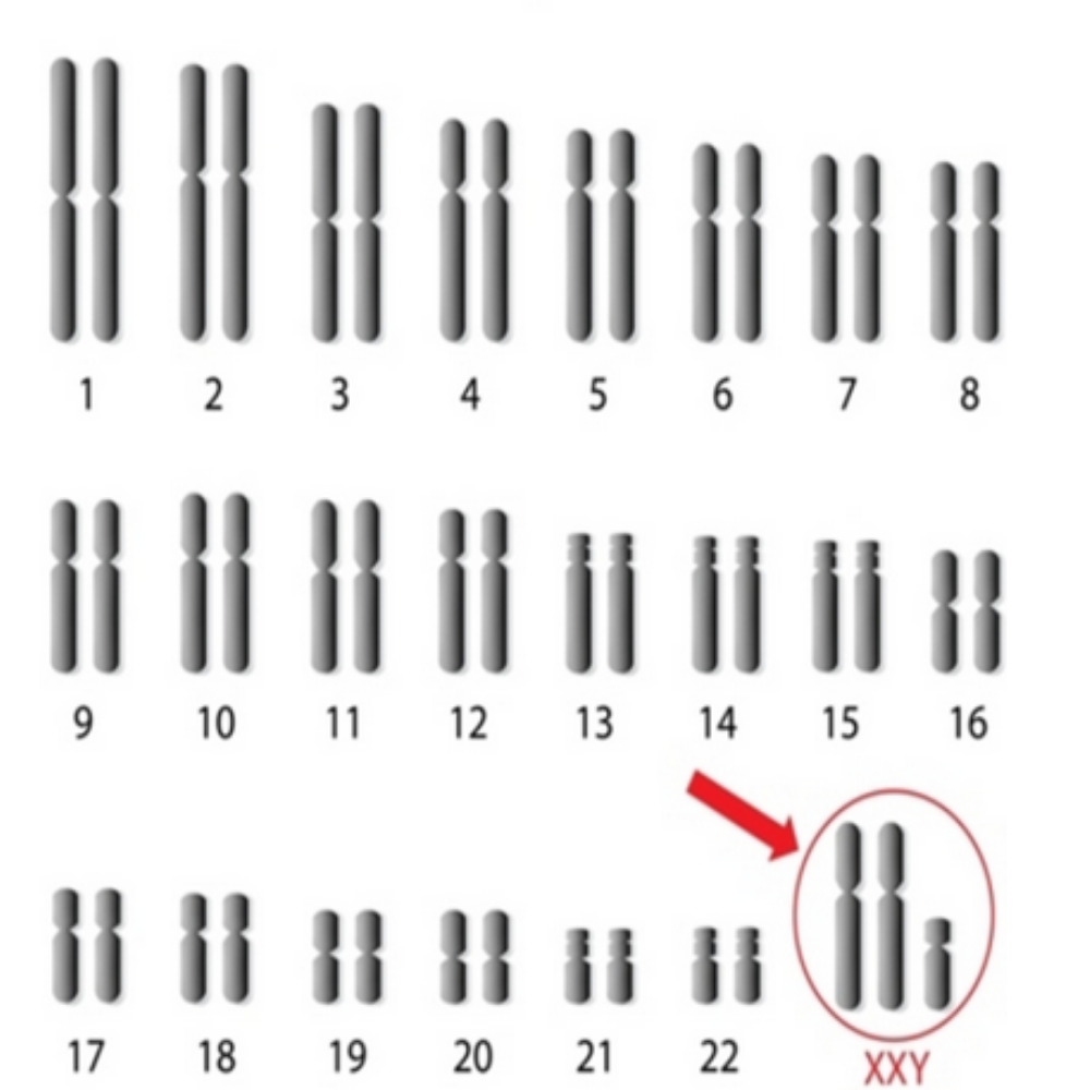 <p>Based on the set of chromosomes shown, what syndrome does this person have?</p>