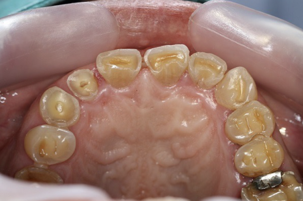 <p>hard tissue loss involving >/= 50% of the surface area </p>
