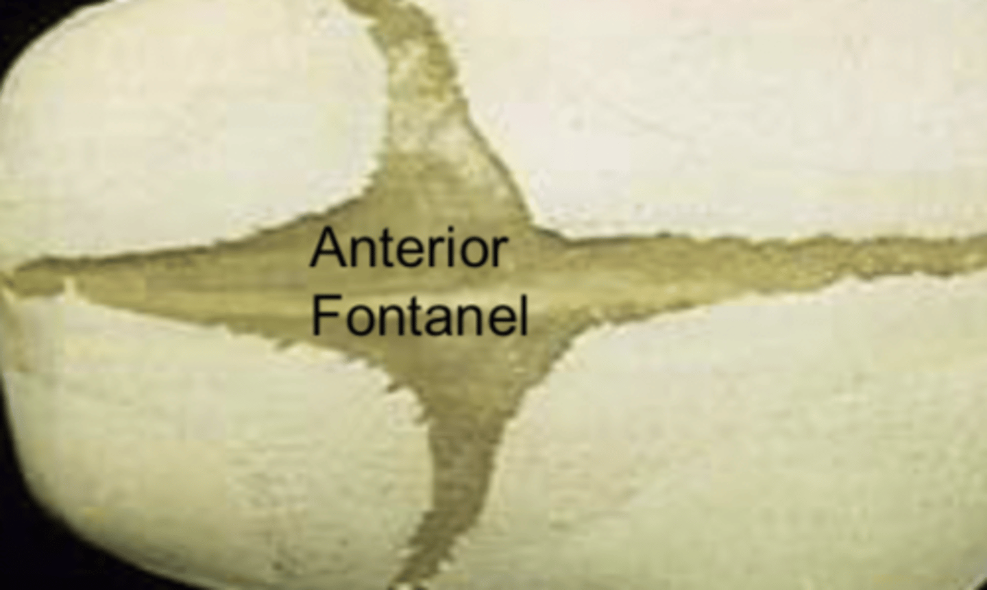 <p>posterior fontanel</p>