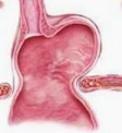 <p>union gastroesofagica arriba del diafragma + fondo gastrico sobresale hacia arriba</p>
