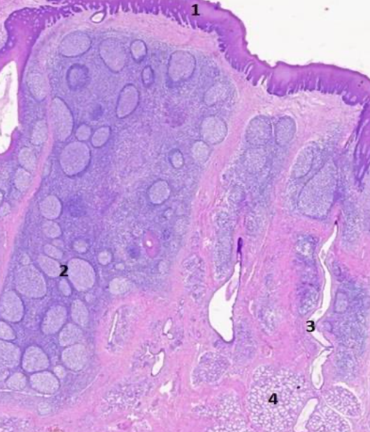 <p>Se ubica 1/3 posterior de la lengua. Está formado por <strong>tejido linfoide</strong> (MALT):</p><ul><li><p><strong>Nodular:</strong> Linfocito B <span style="color: red"><em>(predomina)</em></span></p></li><li><p><strong>Difuso:</strong> Linfocito T</p></li></ul><p></p>