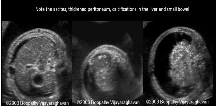 <p>a calcification in the liver is commonly assoc w</p><p>a) ambiguous genitalia</p><p>b) umbilical vein thrombosis</p><p>c) meconium peritonitis</p><p>d) renal calculi </p>