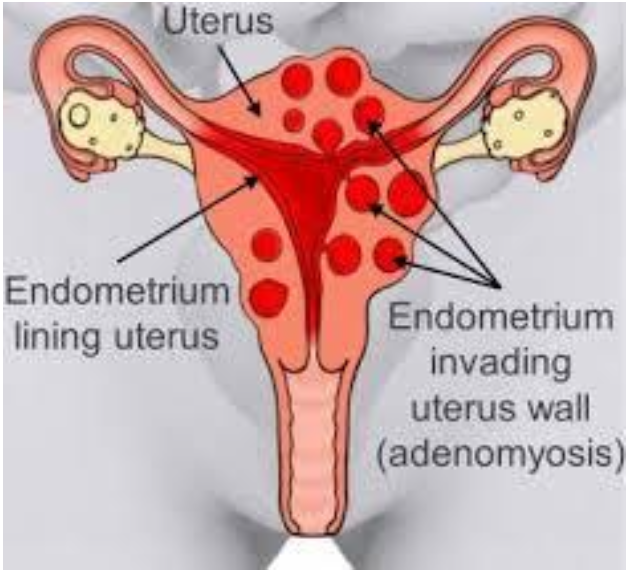 <p> Benign disease</p><p class="p1"> Diffuse or focal</p><p class="p1"> Global infiltration of endometrium</p><p class="p1"> <strong><em>Sonographically presents as bulky enlarged uterus without focal mass</em></strong></p><p class="p1"> <strong><em>Adenomyosis is ectopic occurrence of endometrial tissue within myometrium</em></strong>; more common in</p><p class="p1">posterior aspect</p><p class="p1"> The tissue penetration usually reaches a depth of at least 2.5 mm from the basal layer of the</p><p class="p1">endometrium.</p><p class="p1"> Adenomyosis may arise from multiple pregnancies and deliveries with subsequent uterine shrinking.</p><p class="p1">Elevated estrogen levels may also promote the growth of myometrial islands of endometrial tissue.</p><p class="p1"> Adenomyosis is often classified into diffuse and focal forms. The more common form is diffuse</p><p class="p1">adenomyosis.</p><p class="p1"> <strong><em>It represents a reactive hypertrophy of the myometrial muscle, which produces uterine enlargement</em></strong></p><p class="p1"><strong><em>but usually not to the extent seen with leiomyomas.</em></strong></p><p class="p1"> Focal adenomyosis is sometimes called adenomyoma, referring to isolated implants that typically</p><p class="p1">cause reactive hypertrophy of the surrounding myometrium and produce diffuse uterine enlargement.</p><p class="p1"> Less common than the diffuse form, focal adenomyosis (adenomyoma) lacks a hypoechoic border that</p><p class="p1">is seen with fibroids, not endometriosis. Adenomyosis can be appropriately managed with hormone</p><p class="p1">therapy.</p><p class="p1"> Patients with adenomyosis are often <strong><em>multiparous</em></strong> and <strong><em>older than patients with endometriosis</em></strong>.</p><p class="p1"> The patient presents with heavy, painful abnormal menses, and on physical examination, the uterus is</p><p class="p1">found to range from normal to three times normal size and is globular in contour, boggy, and</p><p class="p1">somewhat tender.</p><p class="p1"> <strong>Hypermenorrhea</strong></p><p class="p2">➢ Abnormal uterine bleeding</p><p class="p1"> <strong>Menorrhagia</strong></p><p class="p2">➢ Prolonged/profuse uterine bleeding</p><p class="p1"> <strong>Metrorrhea</strong></p><p class="p2">➢ Irregular, acyclic bleeding</p><p class="p1"> <strong>Dysmenorrhea</strong></p><p class="p2">➢ Pelvic pain during menstruation</p><p class="p2"> Sonographically, <strong><em>diagnosis may be difficult</em></strong>.</p><p class="p1"> Most common presentation of extensive adenomyosis is:</p><p class="p1">➢ Diffuse uterine enlargement</p><p class="p1">➢ Thickening of posterior myometrium</p><p class="p1">➢ Indistinct border between endometrium and myometrium (involved area being slightly more</p><p class="p1">anechoic than normal myometrium)</p><p class="p1"> Has been described as <strong><em>Swiss cheese or honeycomb pattern</em></strong></p><p class="p1"> Calcifications resulting from prior instrumentation are seen along inner myometrium and cervix.</p><p class="p1"> Doppler studies have also proven helpful in differentiating uterine pathology, as color flow studies of</p><p class="p1">uterine masses show that myomas and sarcomas typically demonstrate a feeding artery, but</p><p class="p1">adenomyosis rarely demonstrates feeding arteries.</p><p class="p1"> Adenomyosis is not always reliably diagnosed by ultrasonography, and</p><p class="p1">caution is advised because these findings are similar in appearance to</p><p class="p1">uterine myomas, muscular hypertrophy, myometrial contractions,</p><p class="p1">endometritis, endometrial carcinoma, and the presence of increased</p><p class="p1">endometrial secretions.</p><p class="p1"> The presence of myomas has been shown to limit the ability to diagnose</p><p class="p1">the severity of adenomyosis.</p><p class="p1"> Although not reliably diagnosed by ultrasonography, <strong><em>adenomyosis is well</em></strong></p><p class="p1"><strong><em>characterized by MRI, which currently is thought by many to be the</em></strong></p><p class="p1"><strong><em>best technique for the presurgical diagnosis of adenomyosis</em></strong>.</p>