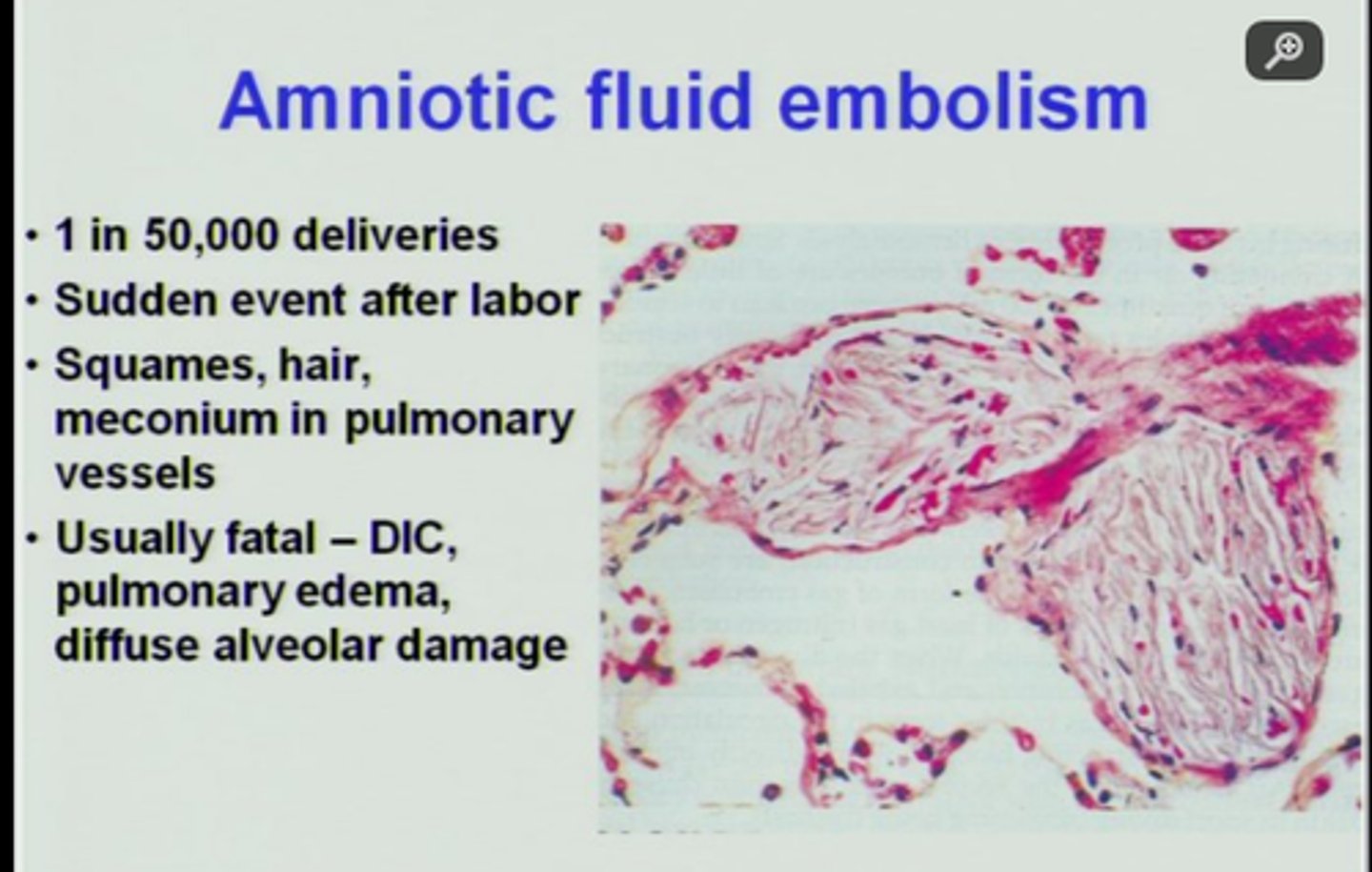 <p>referred to as anaphylactoid syndrome of pregnancy, may occur in pregnancy, labor, delivery, and the immediate postpartum period.</p><p>is caused when amniotic fluid enters maternal circulation and is associated with a maternal mortality rate of 32%.</p><p>Initial symptoms include respiratory failure and cardiac arrest.</p><p>If the patient survives an amniotic fluid embolism, she is at risk for hemorrhagic shock with disseminated intravascular coagulation.</p>