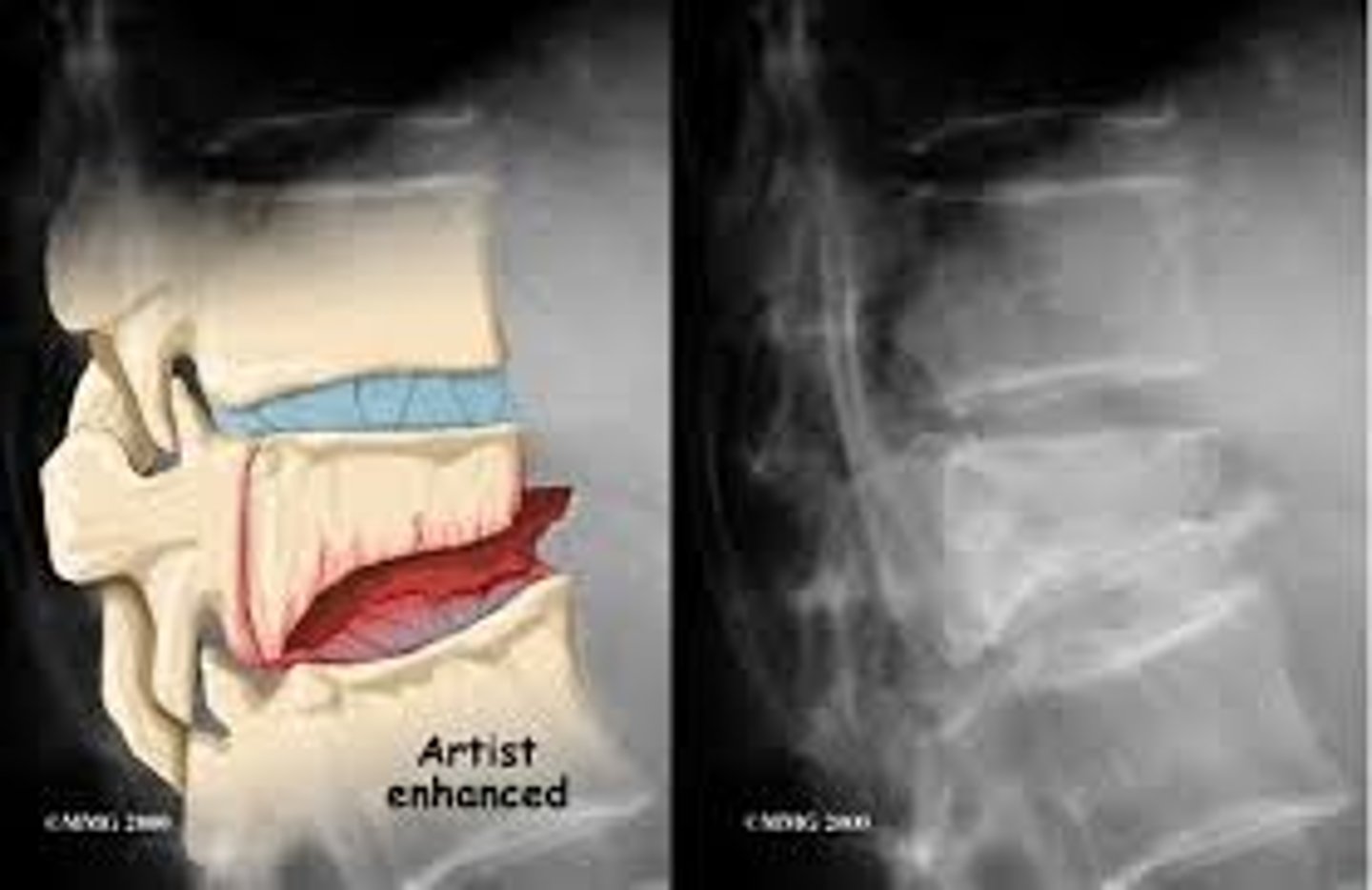<p>collapse of vertebrae, usually secondary to osteoporosis, no neuro deficit, wedge-shaped deformity</p><p>CT- best at identifying</p>