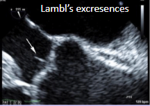 <p>Small, filiform, fibrous strands at coaptation sites.</p><p>Typically seen on the aortic valve.</p><p>Can be mistaken for a mass.</p>