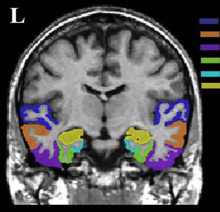 <p>Temporal Lobes: What color goes with each? </p>