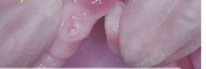 <p>A flabby ridge caused by fibrous replacement of alveolar bone, which does not provide good support because it is wobbly</p><p>A denture should have a firm foundation of soft tissues underneath to stop it moving towards tissues or tipping</p>