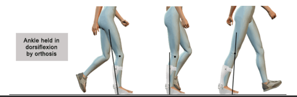 <p>Increased dorsiflexion will provide good toe </p><p>clearance but will promote a knee flexion </p><p>moment.</p><p></p><p>Increased dorsiflexion will assist patients with </p><p>increased extensor tone and increased </p><p>hyperextension of the knee.</p>