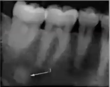 <p>What is idiopathic osteosclerosis?</p>