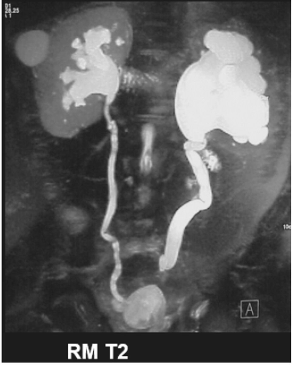 <p>Porque el líquido (orina) se ve blanco naturalmente.</p><p>RIÑON IZQUIERDO CON HIDRONEFROSIS. PARENQUIMIA MUY REDUCIDO POR FALTA IRRIGACION </p>