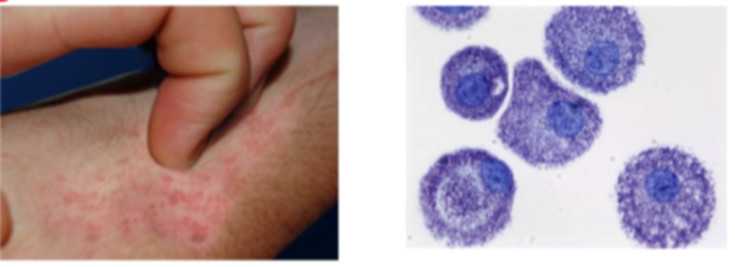 <p>- d/t mast cell stimulation &amp; histamine release</p><p>- patient may scratch skin to a point where wounds form &amp; end up not healing as quick as immunity may also be suppressed</p>