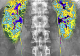 <p><strong>Which of the following patients scheduled for an interventional radiology procedure requiring administration of radiocontrast dye would be considered at high risk for nephrotoxicity? Select all that apply.</strong></p><p>A) A 14-year-old with severe abdominal pain</p><p>B) A 25-year-old with a history of glomerular nephritis who is complaining of severe flank pain</p><p>C) A 67-year-old diabetic undergoing diagnostic testing for new-onset proteinuria</p><p>D) A 45-year-old with elevated liver enzymes possibly due to fatty liver cirrhosis</p><p>E) A 53-year-old male undergoing biopsy for a suspicious “spot” on his chest x-ray </p>