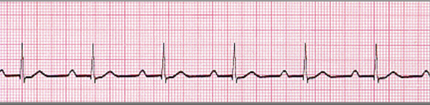 <ul><li><p class="">Looks like NSR except with a prolonged <strong><mark data-color="yellow" style="background-color: yellow; color: inherit">PR interval: greater than 0.20 seconds</mark></strong>.</p></li><li><p class="">Constant PR interval for each beat.</p></li><li><p class="">Usually asymptomatic and only needs monitoring.</p></li><li><p class="">If <strong>symptomatic</strong>, treat with <strong>atropine</strong>.</p></li></ul><p></p>