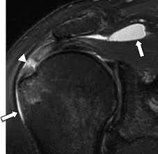 <p>Diagnose this injury. Provide Moi, signs and symptoms and management</p>