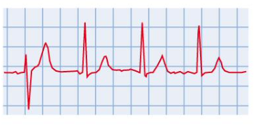 <p>wall of atria contract in unsynchronised manner that prevents filling of ventricles, unclear p wave</p>