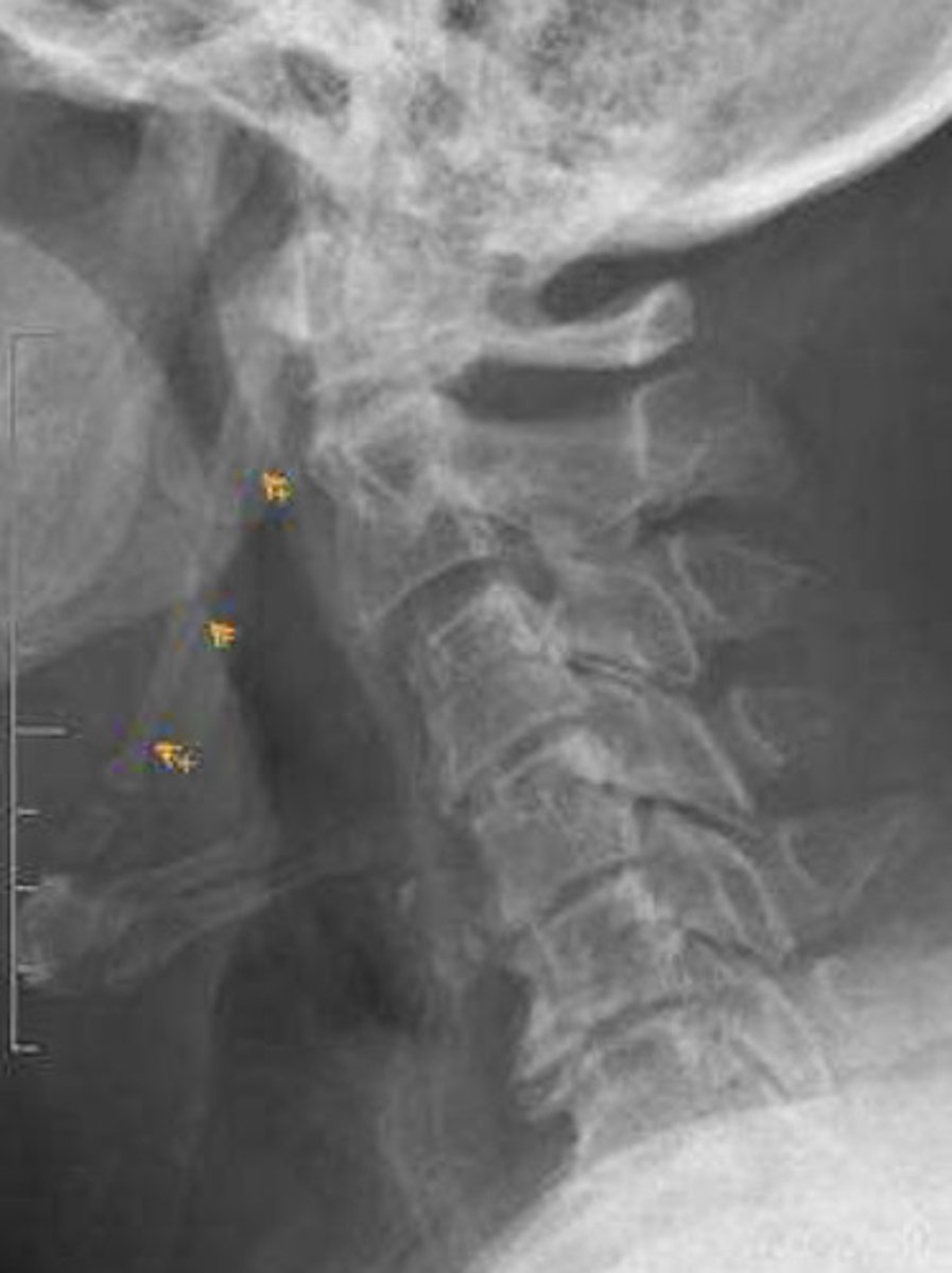 <p>Eagle Syndrome (rare to have clinical symptoms)</p>