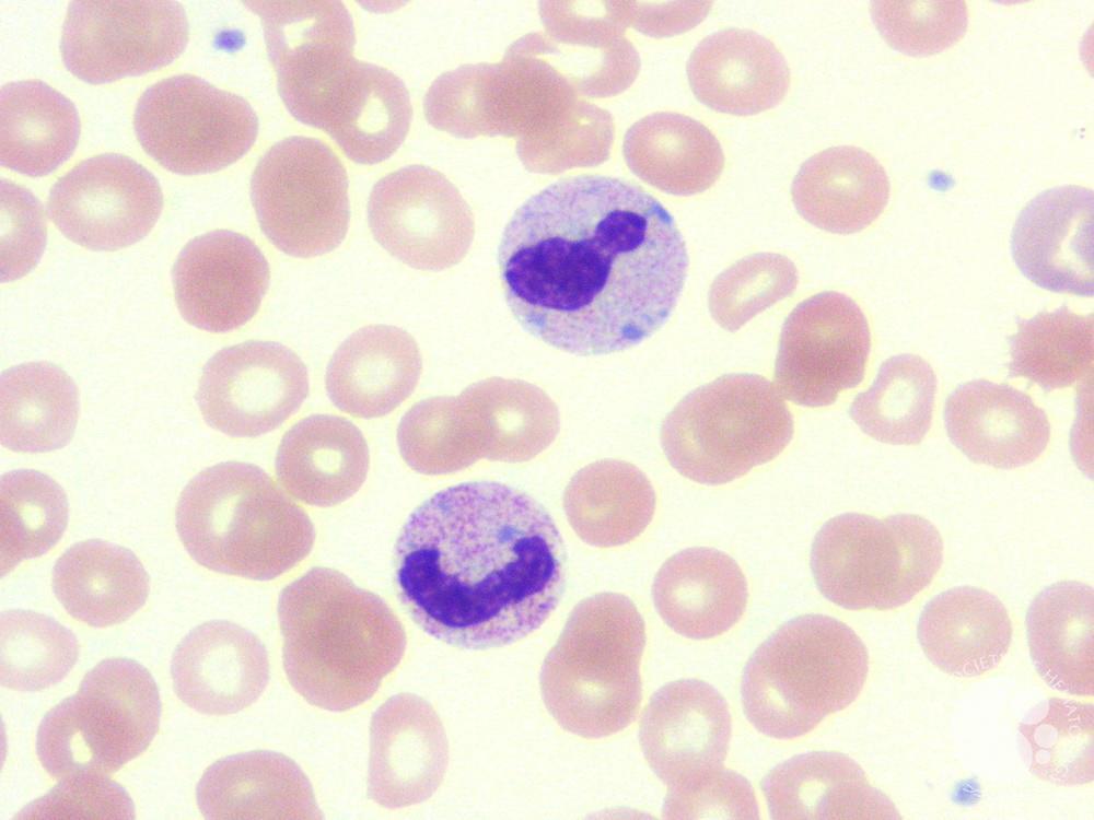 <ul><li><p>cytoplasmic inclusions composed of rRNA</p></li><li><p>1-5 um, rod-shaped, bluish-gray</p></li><li><p>seen in <em>neutrophils</em>, some in <em>monocytes</em> and <em>bands</em></p></li><li><p><strong>occurs in pregnancy, May-Hegglin anomaly, and bacterial infections</strong></p></li></ul><p></p>