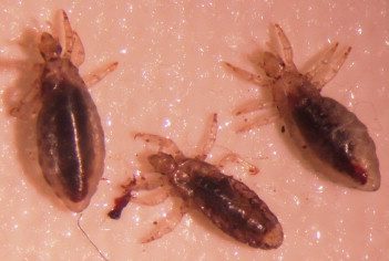 <p>C. Human lice</p><div data-type="horizontalRule"><hr></div><p><em>R. prowazekii</em> is transmitted by the <strong>human lice/body louse (Pediculus humanus corporis)</strong>. The louse defecates infected feces on the skin while feeding, and scratching inoculates the organism into the skin. This causes <strong>epidemic typhus</strong>, typically associated with <strong>crowded, unhygienic conditions</strong> like refugee camps and prisons.</p>