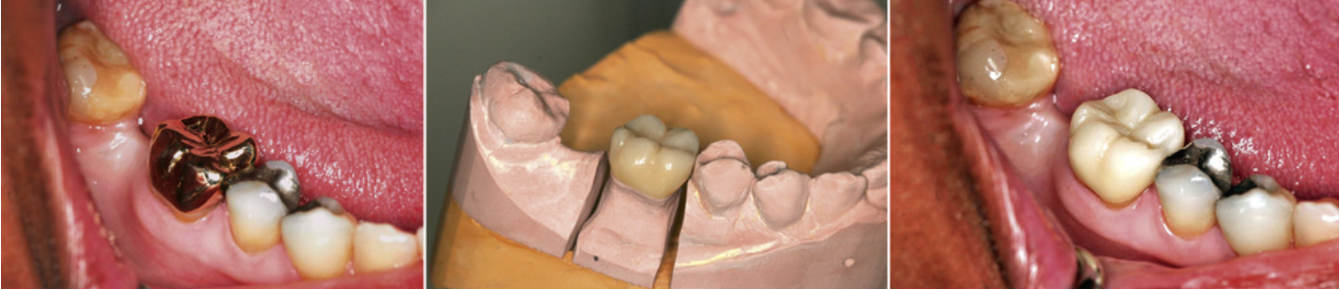 <p>Very strong </p><p>Acceptable aesthetics for posterior </p><p>Less tooth reduction </p><p>Less wear of opposing enamel </p><p></p><p>non-uniform colouring due to limited translucency</p><p>colour change after adjustment if glazed layer removed </p>