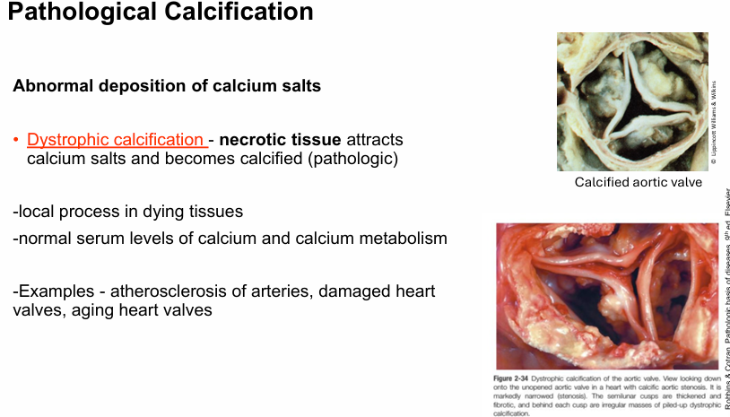 <p>abnormal deposition of calcium salts</p><p></p><p><span style="color: yellow"><strong>dystrophic calcification: </strong></span>necrotic tissue attracts calcium salts and become calcified</p><p>(<span>Jerry, an 80-year-old, has large calcium deposits in his lung tissue secondary to Tuberculosis and caseous necrosis. Jerry’s serum calcium levels remain normal. This form of substance accumulation in the tissues is best described as)</span></p><p><br></p><p>Ex. atherosclerosis, damaged heart valves, aging heart valves</p>