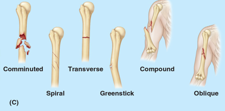 <p>Humeral Midshaft fractures account for 1-3% of all fractures in body, MOI for diaphysis fractures include</p>