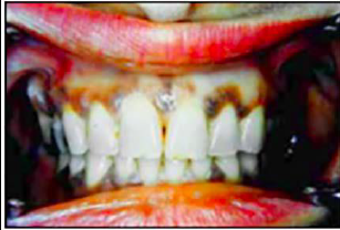 <p>Gingival Pigmentation (Melanoplakia)</p><ul><li><p>Clinical Signs</p></li><li><p>Location</p></li><li><p>Etiology</p></li><li><p>Treatment</p></li></ul><p></p>