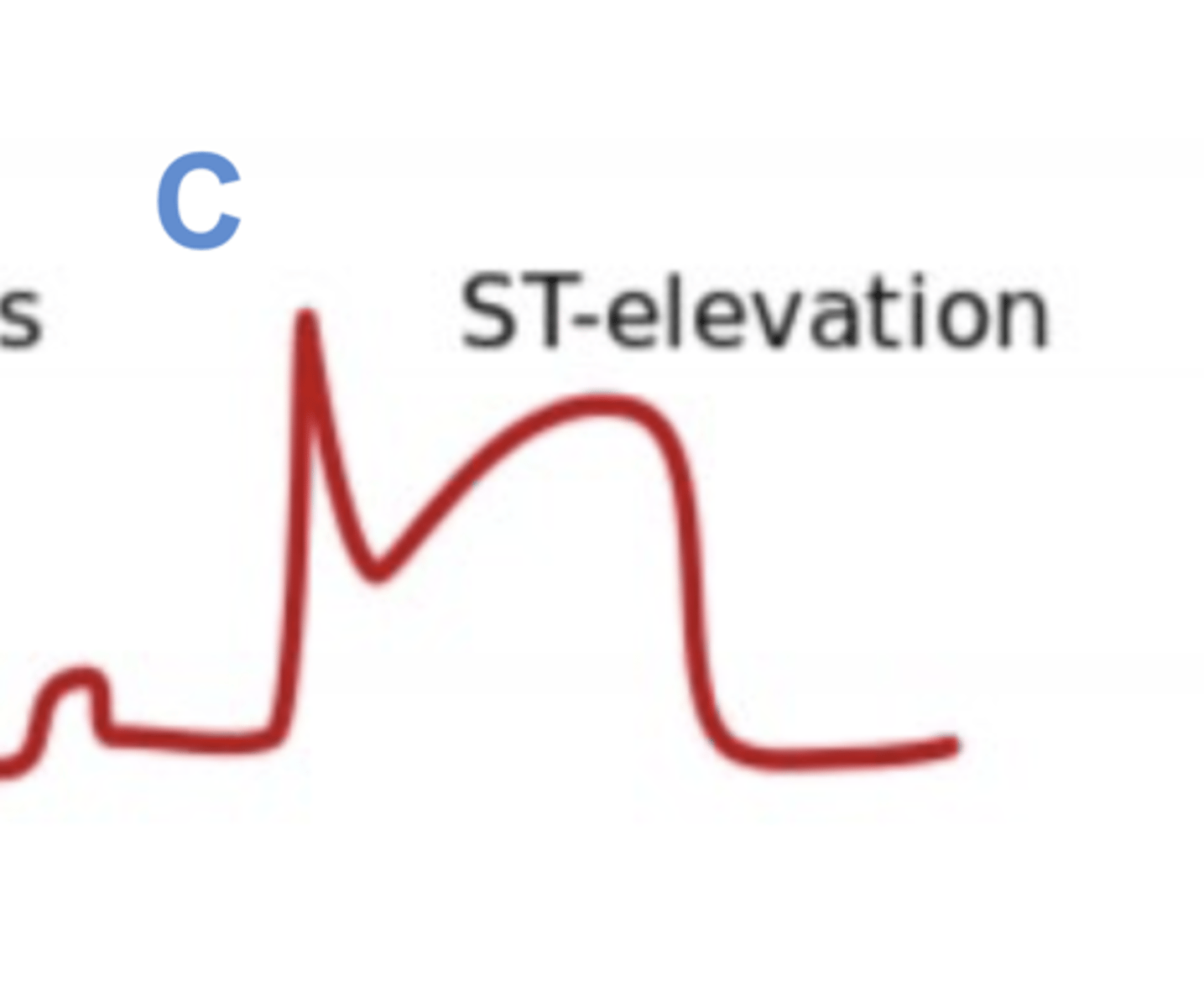 <p>STEMI (transmural infarct)</p>