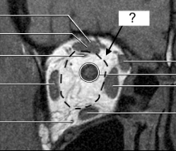 <p>outside of the “cone” created by the extraocular muscles</p>