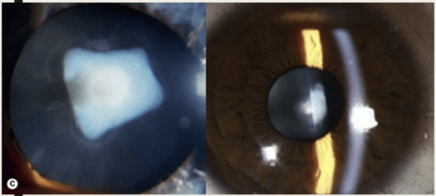 <p>1. shield-like plaque on anterior capsule</p><p>2. wrinkled anterior capsule</p>