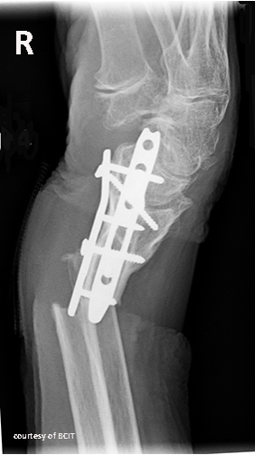 <p>Refracture</p>