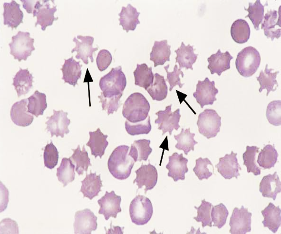 <p>cell with normal or slightly reduced size <u>possessing 3-8 finger-like projections</u> distributed in an irregular manner along cell membrane</p>