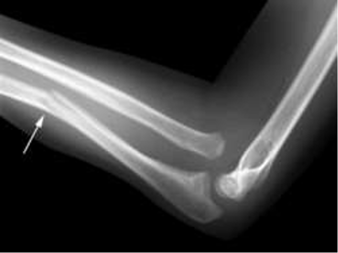 <p>incomplete fracture due to flexibility of young bones; common in forearm</p>