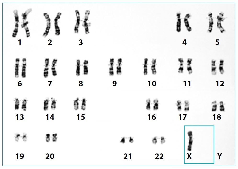 <p>Monosomy 23 (XO)</p>