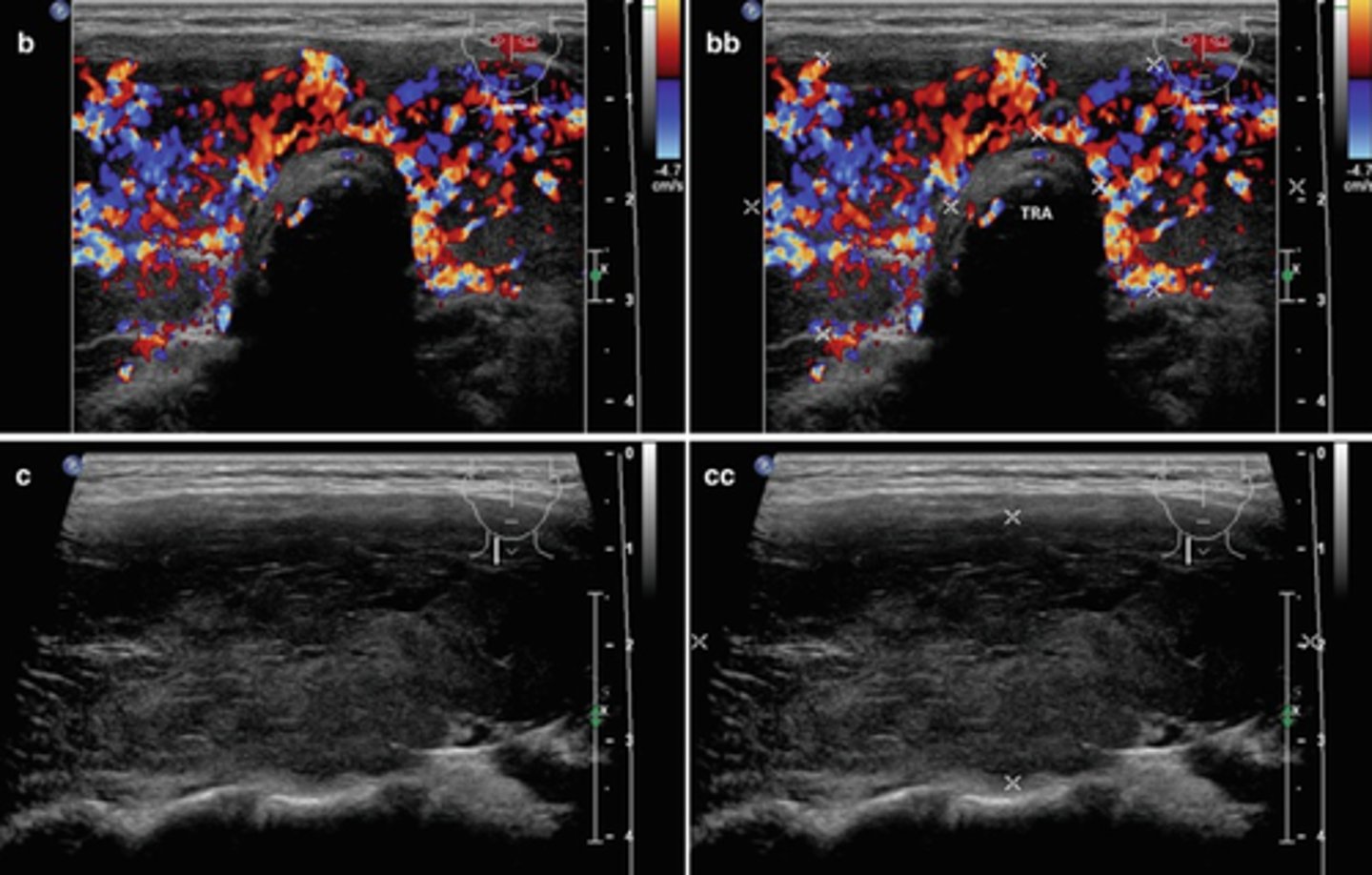<p>-Hyperactivity of the thyroid gland</p><p>-Symptoms include nervousness, exophthalmos, tremors, constant hunger, weight loss, heat intolerance, palpitations, increased heart rate, and diarrhea</p><p>-Causes include toxic adenoma, Graves disease, and trophoblastic tumors</p><p>-If untreated, may lead to cardiac failure</p><p>-Sonographic appearance - normal or enlarged heterogeneous hypervascular thyroid gland</p>